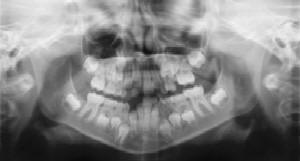 Dental Radiographs (X-Rays) - Pediatric Dentist in Gulfport, MS