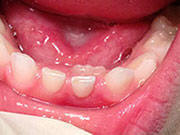 Baby Teeth - Pediatric Dentist in Gulfport, MS