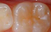 Sealant-Before - Pediatric Dentist in Gulfport, MS