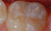 Sealant-After - Pediatric Dentist in Gulfport, MS